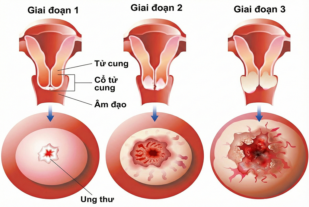 Để ung thư cổ tử cung không còn là … “án tử”